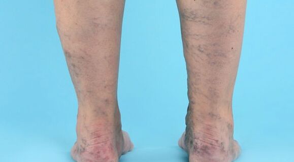 Krankheitserkrankung