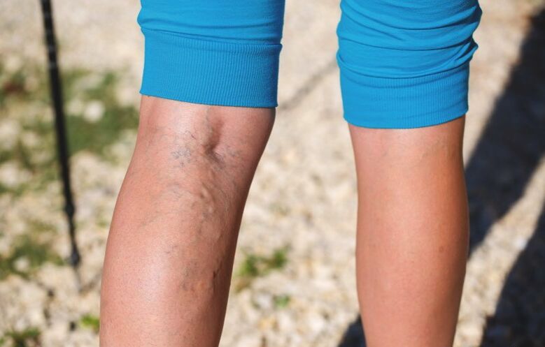 Schäden an den unteren Extremitäten