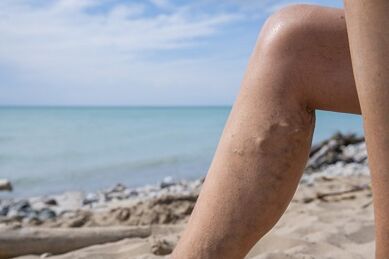 Krampfadern an den Beinen