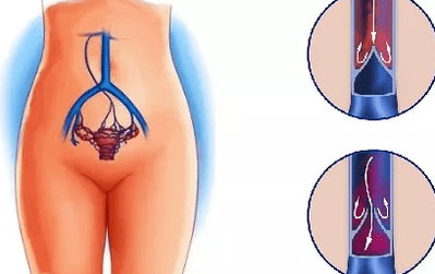Die Gründe für die Entwicklung von Krampfadern des Beckens