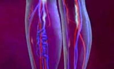 Ursachen und Behandlung von Krampfadern