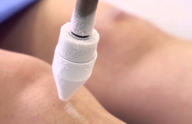 Behandlung von Krampfadern an den Beinen mit Kryotherapie