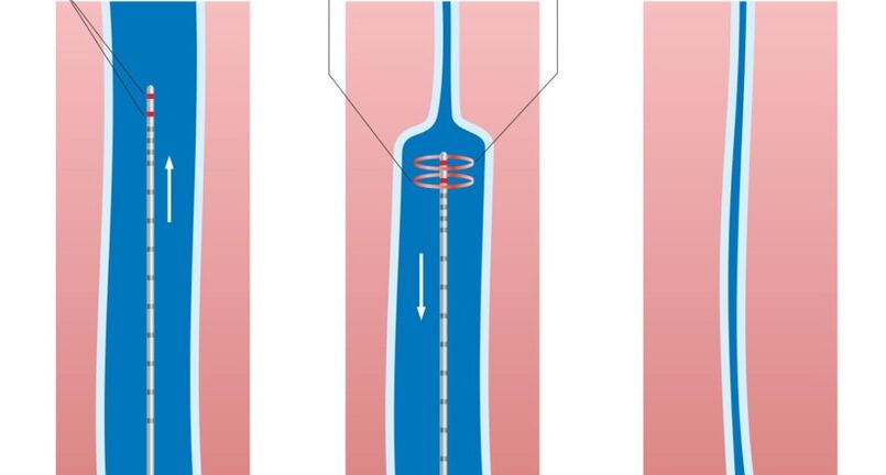 Laserbehandlung von Krampfadern an den Beinen