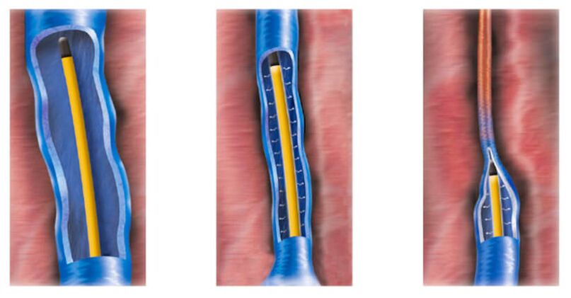 Radiofrequenzablation als Methode zur Behandlung von Krampfadern
