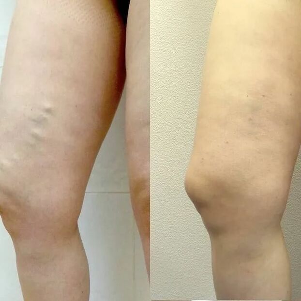 vor und nach der Behandlung von Krampfadern